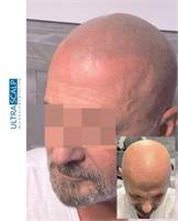 Ultra Scalp Micropigmentation Ryan Krupnick